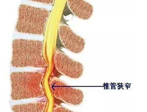 腰椎管狭窄导致的因素有哪些