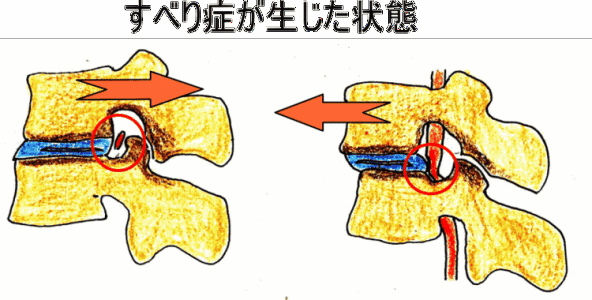 导致后天性椎管狭窄的原因是什么